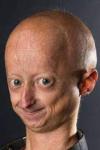 progeria-syndrome Image