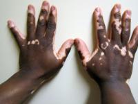 world-vitiligo-day-2 Image