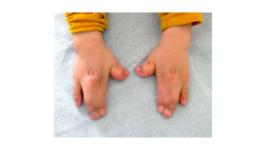 apert-syndrome Image